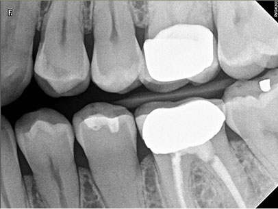 Радиовизиографический снимок зубов