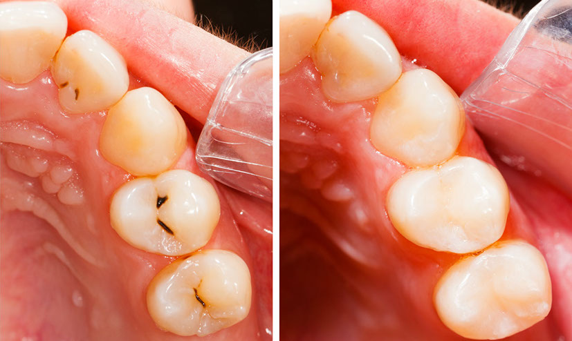 Современные методы лечения зубов у деток 2-4 лет