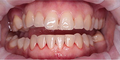 До и после процедуры снятия пигментированного зубного налета